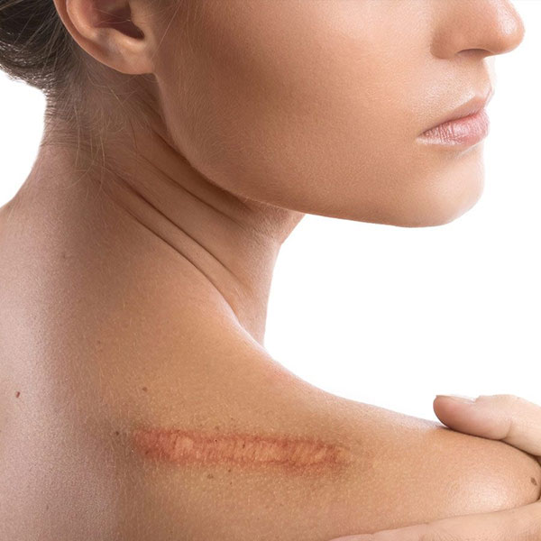 اسکار-یا-جای-زخم-چیست