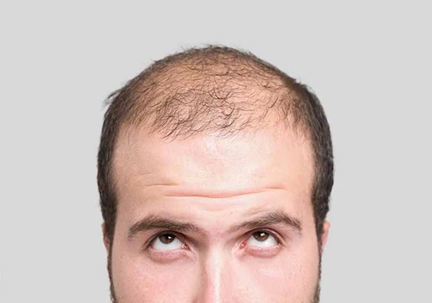 قرص هیر ایکس چیست