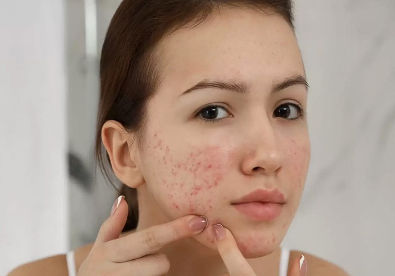 عوارض پیگمنتا