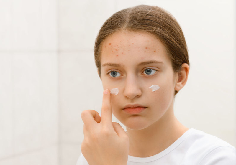 خرید کرم ضد جوش