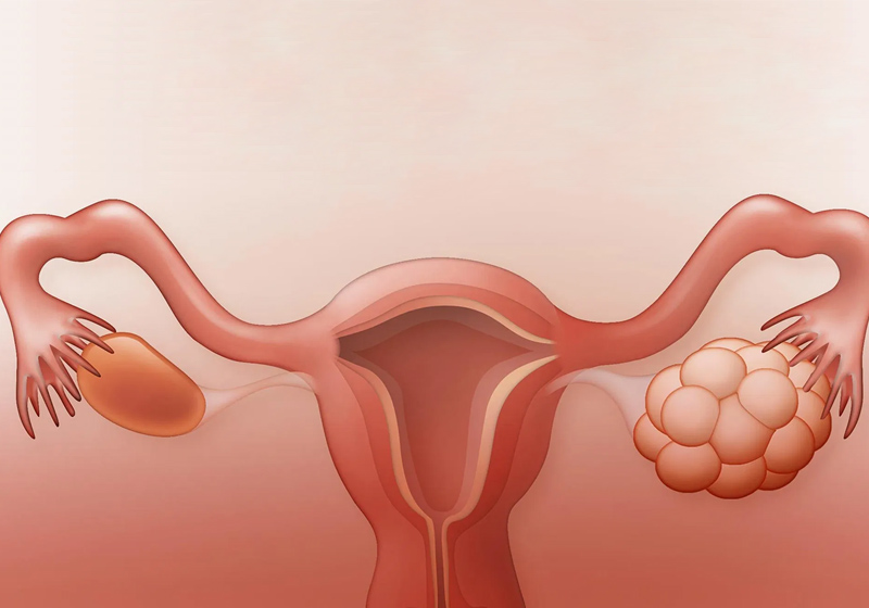 سندروم تخمدان پلی‌کیستیک