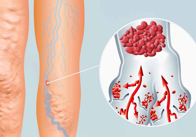 علائم انعقاد خون چیه